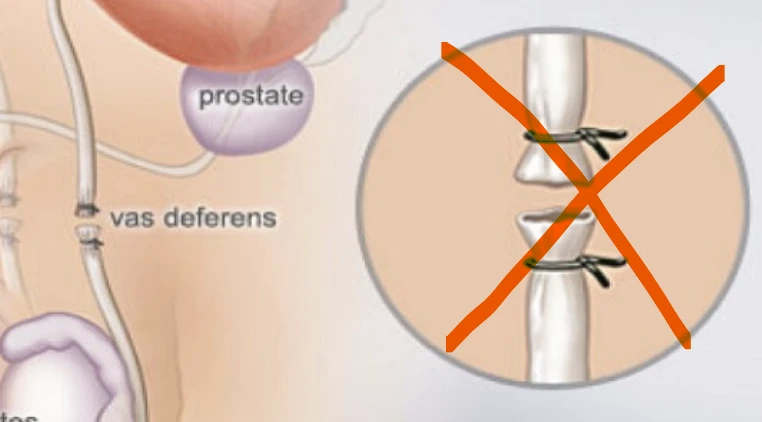 Diagram of the vas deferens and prostate; closure with clips is crossed out.