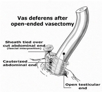 Diagram of the vas deferens after an open-ended vasectomy: cauterized abdominal end, fascial sheath tied over it, testicular end left open.